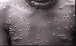 Monkey pox