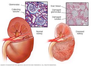 diseased_kidney-tcnews