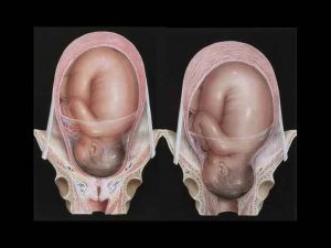 cervical dil