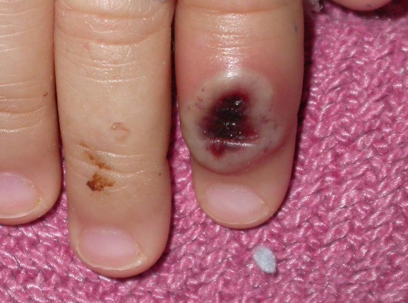 Public Health England confirms two cases of rare monkey pox infection.
