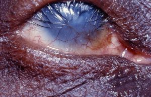 TRACHOMA