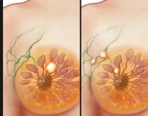 Breast cancer