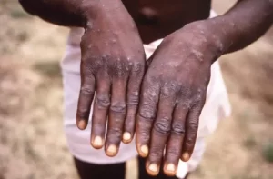 Gombe activates IMS to curtail spread of Monkeypox