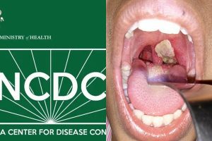 NCDC begins sample collection over diphtheria outbreak in Abuja